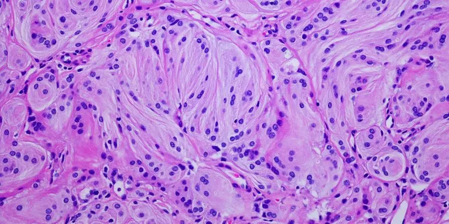 Espectroscopia Raman: O impulso para melhorar a triagem e o diagnóstico do câncer