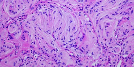 Espectroscopia Raman: O impulso para melhorar a triagem e o diagnóstico do câncer
