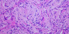 Espectroscopia Raman: O impulso para melhorar a triagem e o diagnóstico do câncer